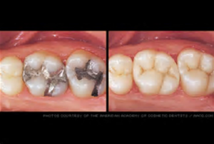 Before and After - Restorative Dentistry